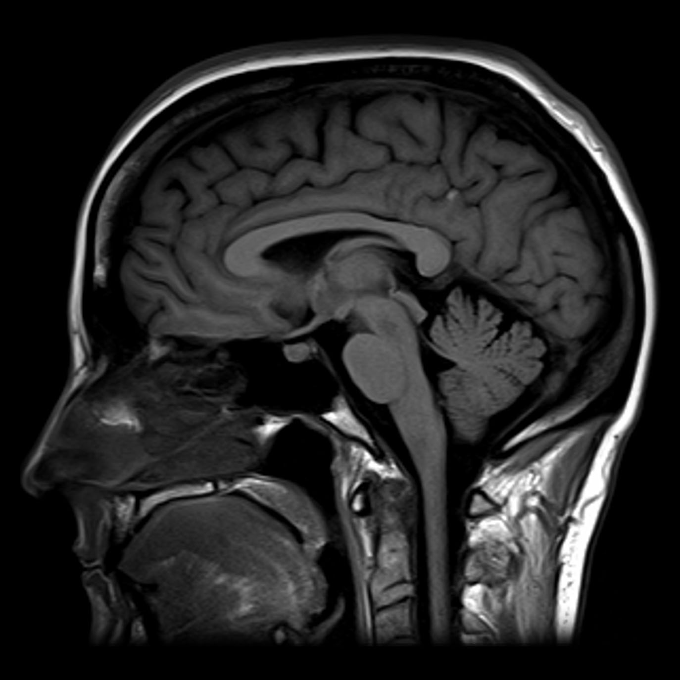 MRI brain sagittal view