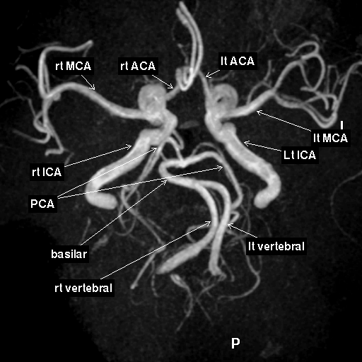 MRA brain vessels